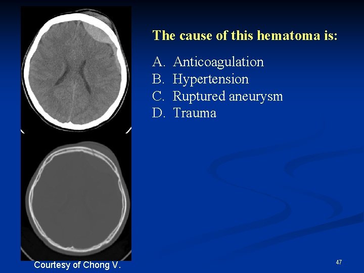 The cause of this hematoma is: A. B. C. D. Courtesy of Chong V.