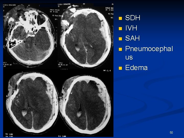 n n n SDH IVH SAH Pneumocephal us Edema 50 