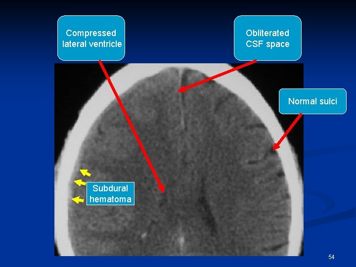 Compressed lateral ventricle Obliterated CSF space Normal sulci Subdural hematoma 54 