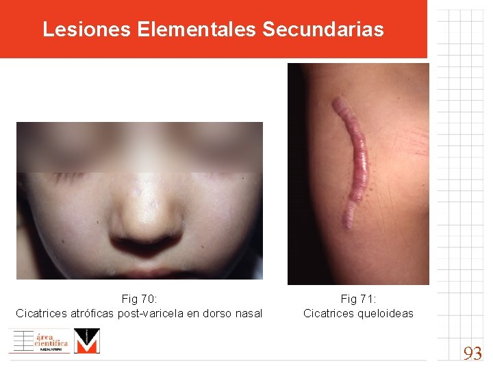 Lesiones Elementales Secundarias Fig 70: Cicatrices atróficas post-varicela en dorso nasal Fig 71: Cicatrices