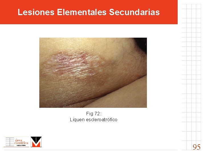 Lesiones Elementales Secundarias Fig 72: Liquen escleroatrófico 95 