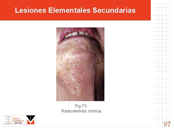 Lesiones Elementales Secundarias Fig 73: Radiodermitis crónica 97 