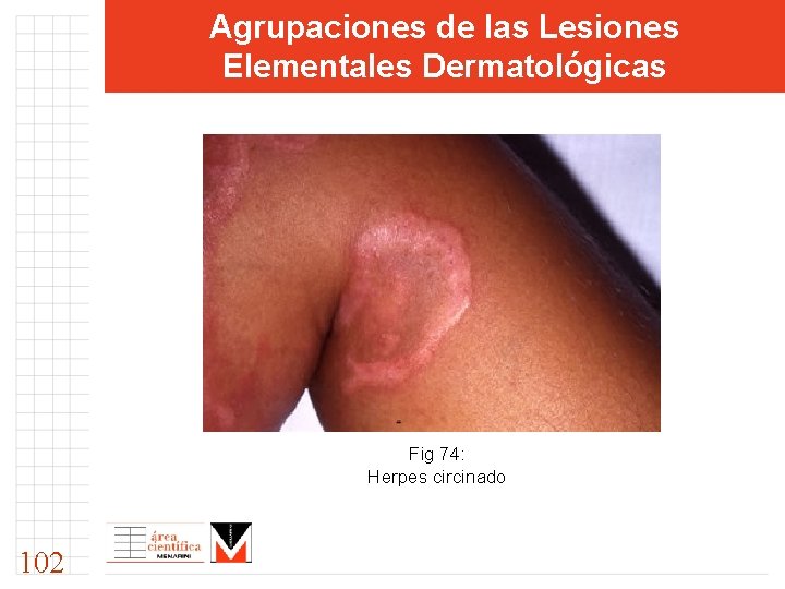 Agrupaciones de las Lesiones Elementales Dermatológicas Fig 74: Herpes circinado 102 