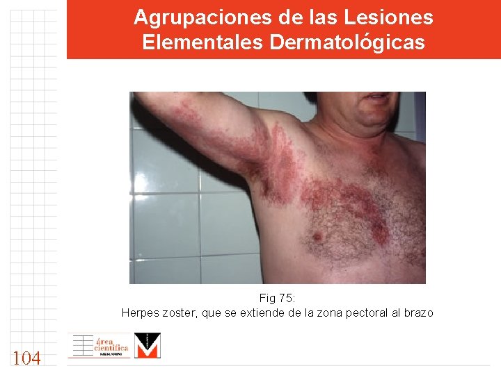 Agrupaciones de las Lesiones Elementales Dermatológicas Fig 75: Herpes zoster, que se extiende de