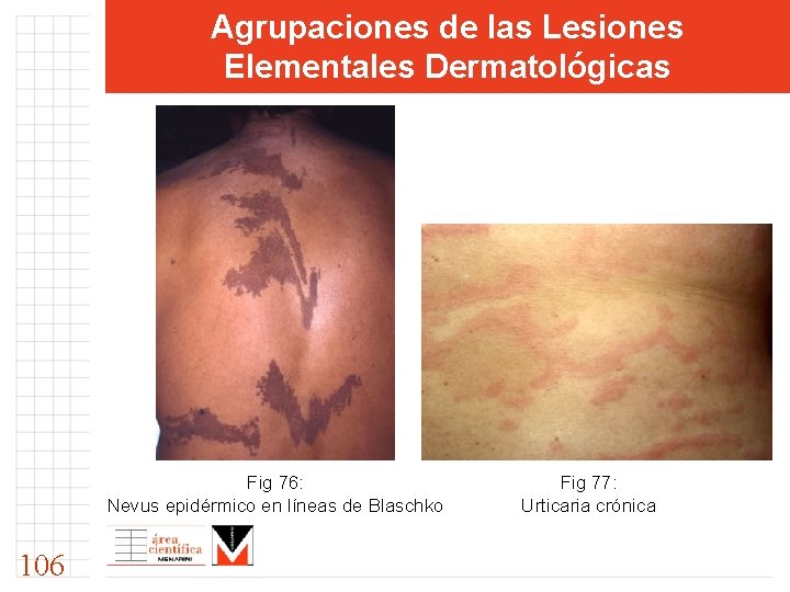 Agrupaciones de las Lesiones Elementales Dermatológicas Fig 76: Nevus epidérmico en líneas de Blaschko