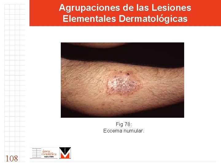 Agrupaciones de las Lesiones Elementales Dermatológicas Fig 78: Eccema numular. 108 