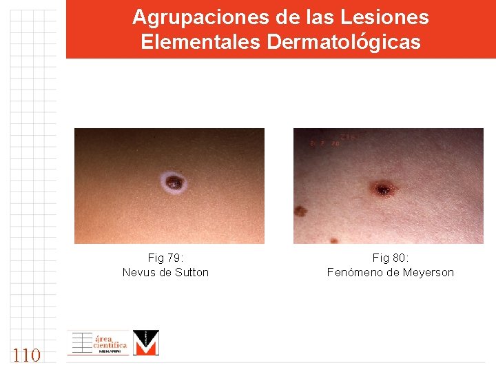 Agrupaciones de las Lesiones Elementales Dermatológicas Fig 79: Nevus de Sutton 110 Fig 80: