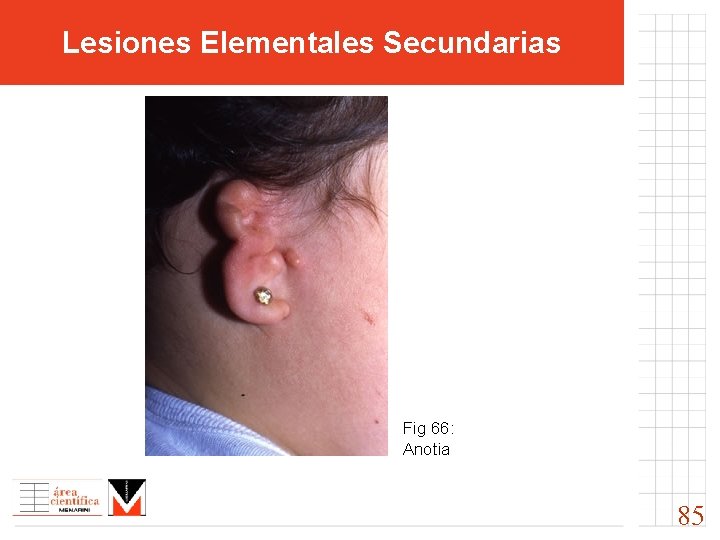 Lesiones Elementales Secundarias Fig 66: Anotia 85 