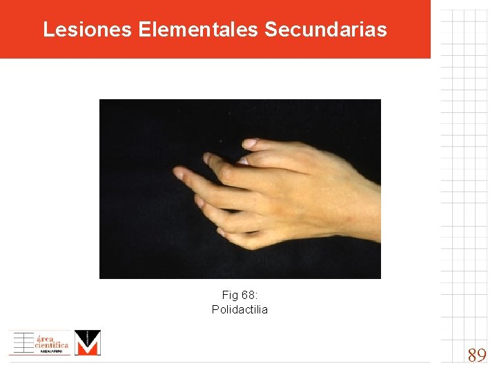 Lesiones Elementales Secundarias Fig 68: Polidactilia 89 