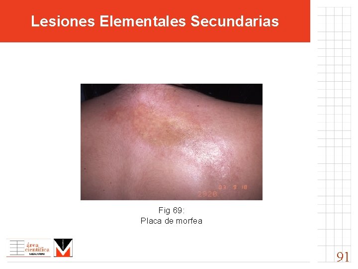 Lesiones Elementales Secundarias Fig 69: Placa de morfea 91 