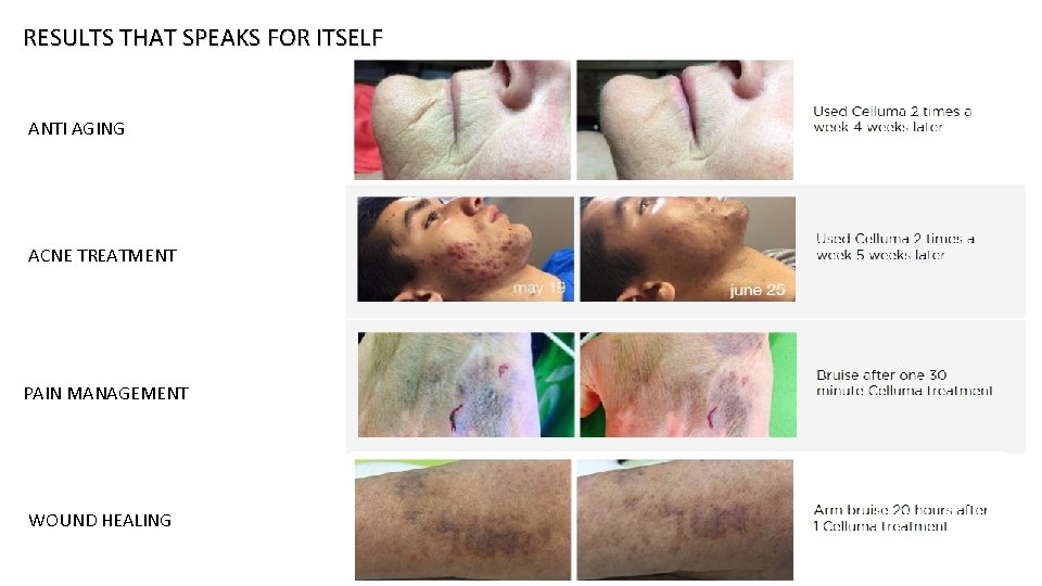 RESULTS THAT SPEAKS FOR ITSELF ANTI AGING ACNE TREATMENT PAIN MANAGEMENT WOUND HEALING 