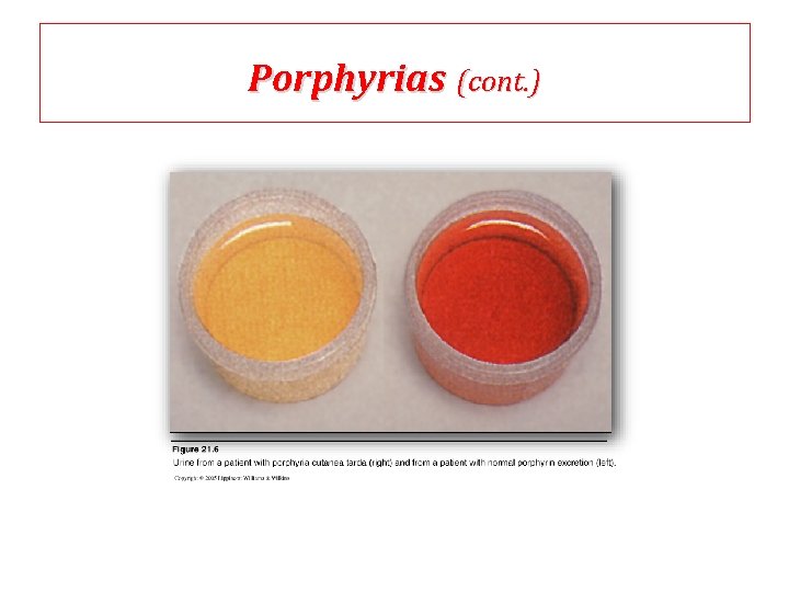 Porphyrias (cont. ) 