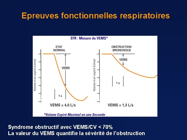 Epreuves fonctionnelles respiratoires Syndrome obstructif avec VEMS/CV < 70% La valeur du VEMS quantifie