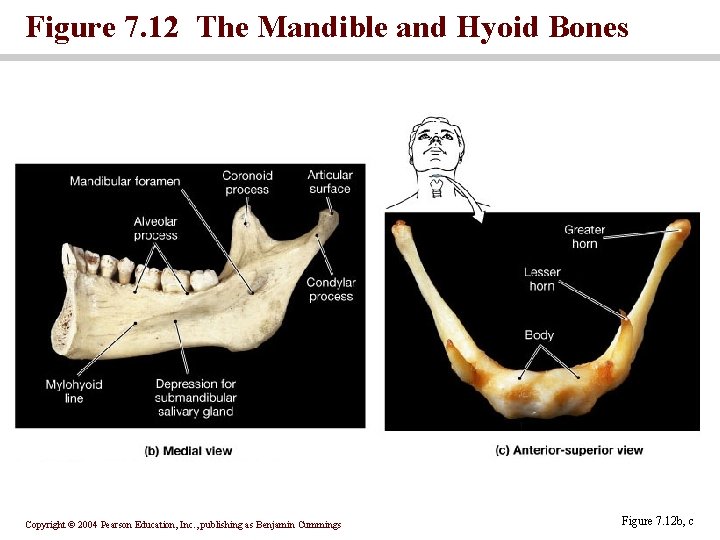 Figure 7. 12 The Mandible and Hyoid Bones Copyright © 2004 Pearson Education, Inc.