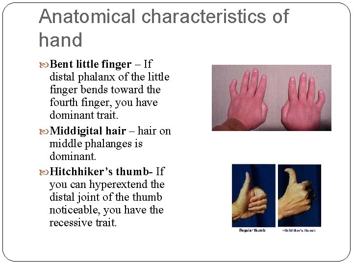 Anatomical characteristics of hand Bent little finger – If distal phalanx of the little
