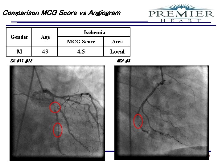 Comparison MCG Score vs Angiogram Gender Age M 49 CX #11 #12 Confidential Ischemia