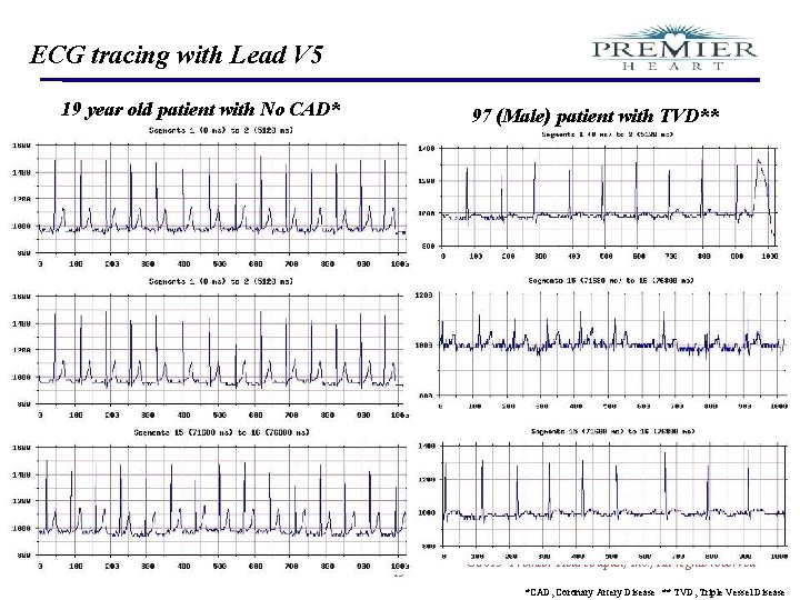 ECG tracing with Lead V 5 19 year old patient with No CAD* Confidential