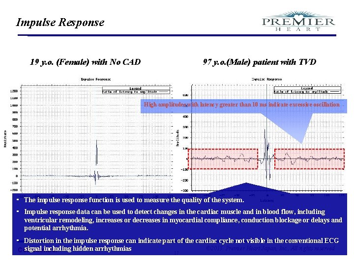 Impulse Response 19 y. o. (Female) with No CAD 97 y. o. (Male) patient