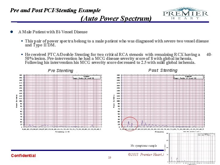 Pre and Post PCI/Stenting Example (Auto Power Spectrum) l A Male Patient with Bi-Vessel