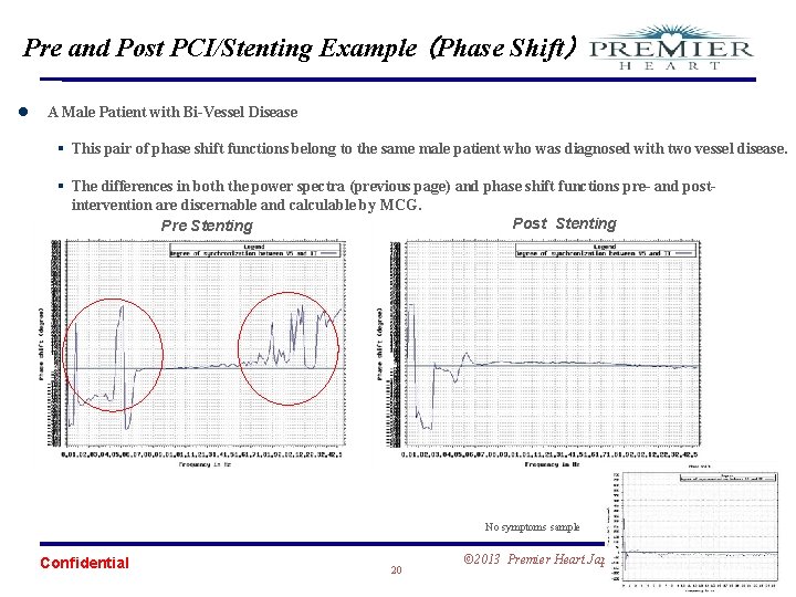 Pre and Post PCI/Stenting Example （Phase Shift） l A Male Patient with Bi-Vessel Disease