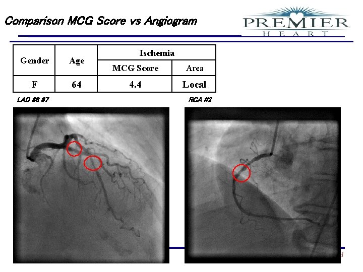 Comparison MCG Score vs Angiogram Gender Age F 64 LAD #6 #7 Confidential Ischemia
