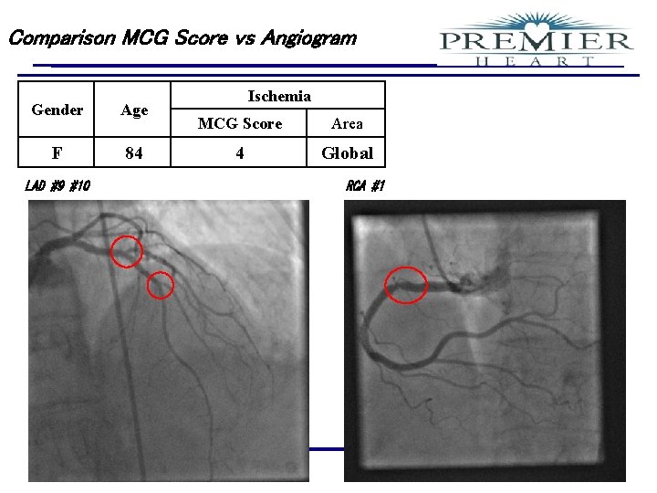 Comparison MCG Score vs Angiogram Gender Age F 84 LAD #9 #10 Confidential Ischemia