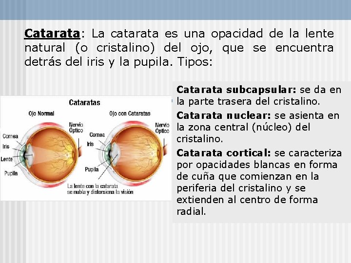 Catarata: La catarata es una opacidad de la lente natural (o cristalino) del ojo,