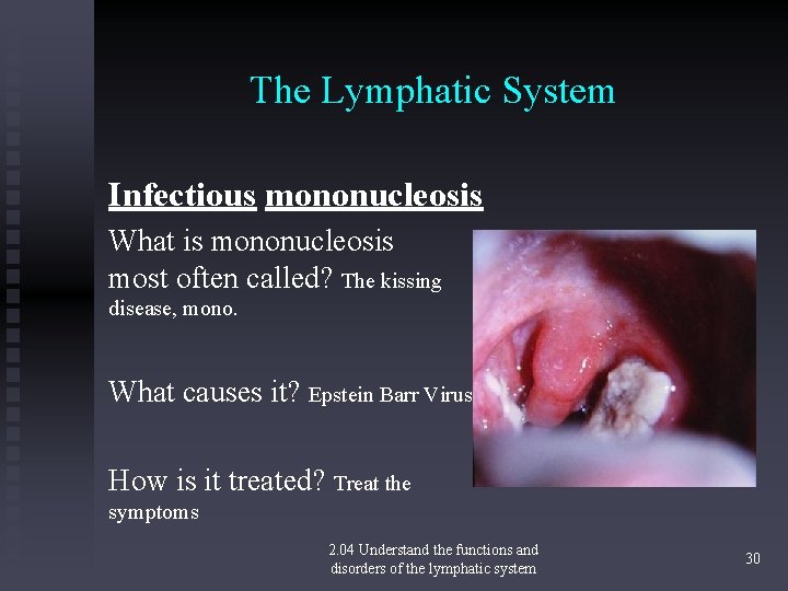 The Lymphatic System Infectious mononucleosis What is mononucleosis most often called? The kissing disease,