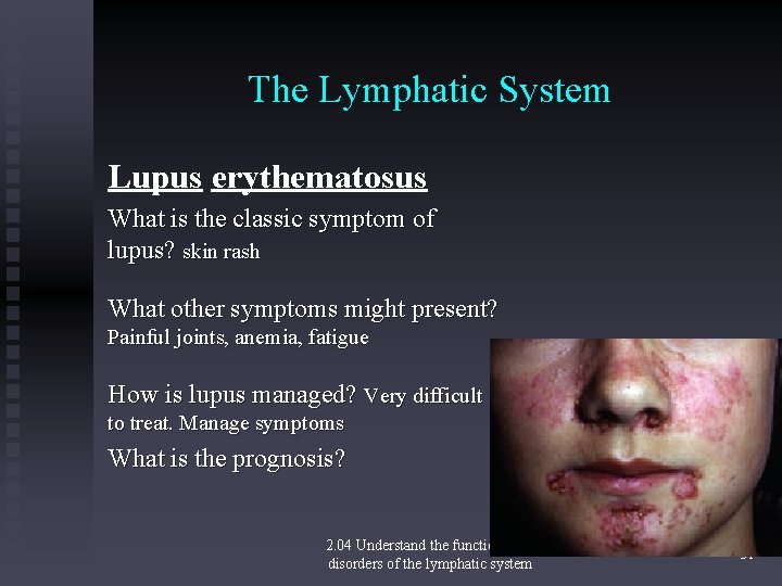 The Lymphatic System Lupus erythematosus What is the classic symptom of lupus? skin rash