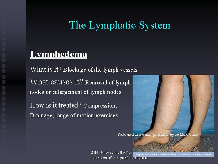 The Lymphatic System Lymphedema What is it? Blockage of the lymph vessels What causes