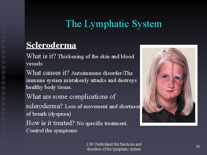 The Lymphatic System Scleroderma What is it? Thickening of the skin and blood vessels