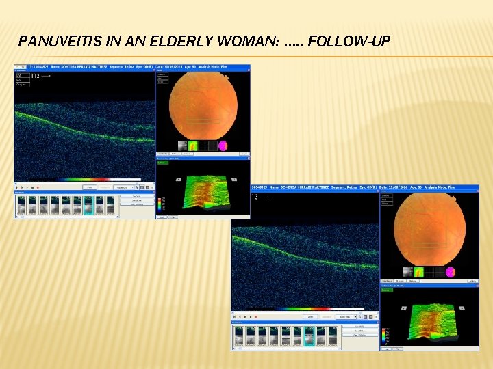 PANUVEITIS IN AN ELDERLY WOMAN: …. . FOLLOW-UP 
