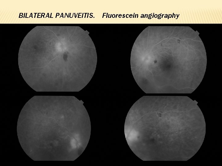 BILATERAL PANUVEITIS. Fluorescein angiography 