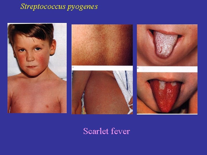 Streptococcus pyogenes Scarlet fever 