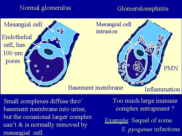 Normal glomerulus Glomerulonephritis Mesangial cell intrusion Mesangial cell Endothelial cell, has 100 nm pores