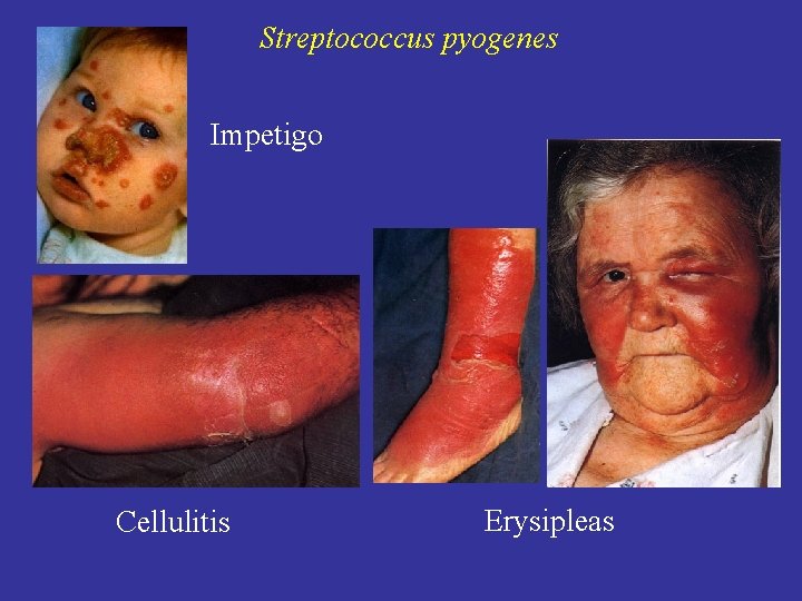Streptococcus pyogenes Impetigo Cellulitis Erysipleas 
