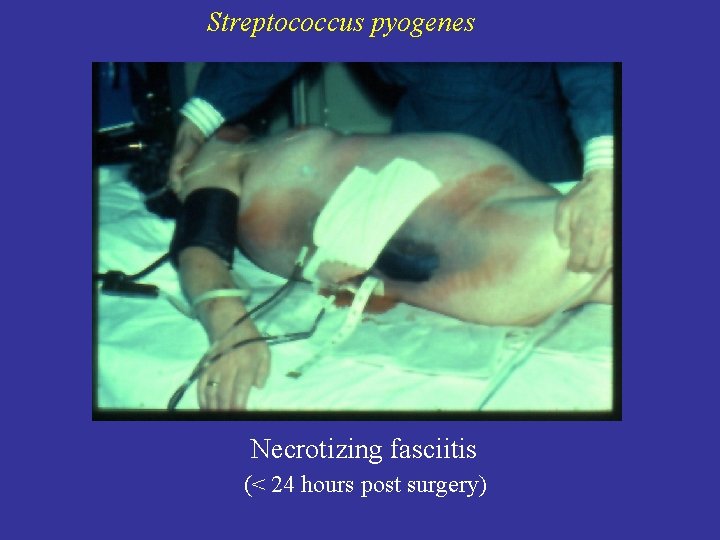 Streptococcus pyogenes Necrotizing fasciitis (< 24 hours post surgery) 