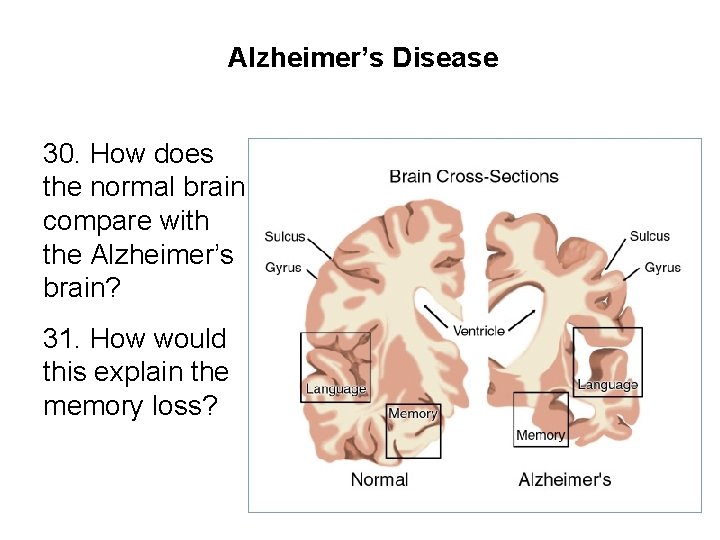 Alzheimer’s Disease 30. How does the normal brain compare with the Alzheimer’s brain? 31.