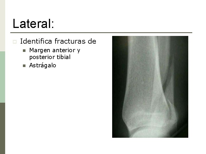 Lateral: p Identifica fracturas de n n Margen anterior y posterior tibial Astrágalo 