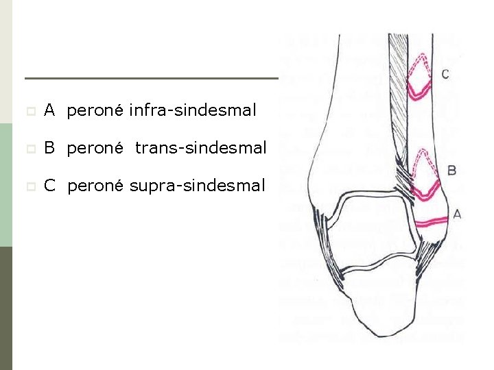 p A peroné infra-sindesmal p B peroné trans-sindesmal p C peroné supra-sindesmal 