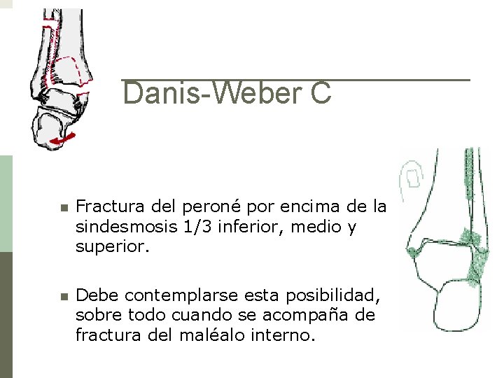 Danis-Weber C n Fractura del peroné por encima de la sindesmosis 1/3 inferior, medio