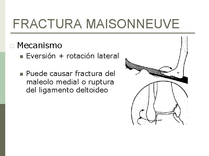 FRACTURA MAISONNEUVE p Mecanismo n Eversión + rotación lateral n Puede causar fractura del