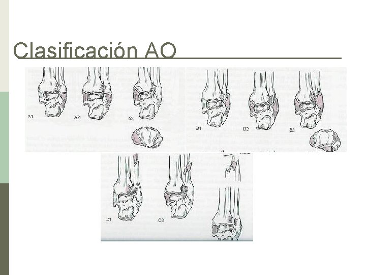 Clasificación AO 