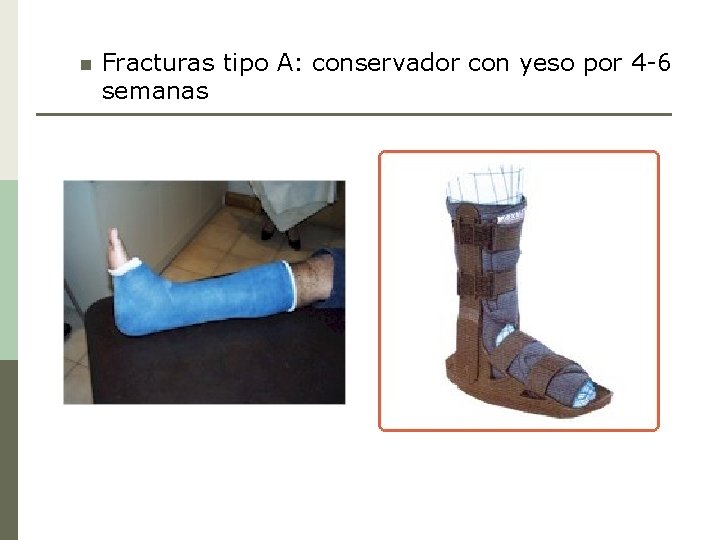 n Fracturas tipo A: conservador con yeso por 4 -6 semanas 