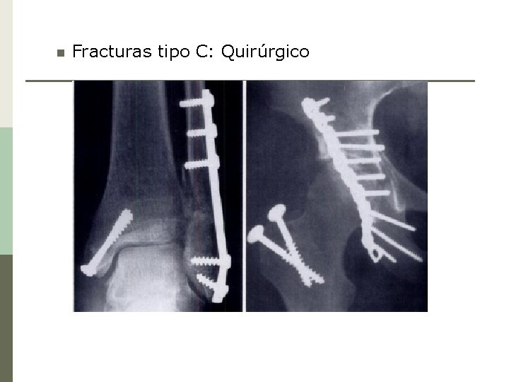 n Fracturas tipo C: Quirúrgico 