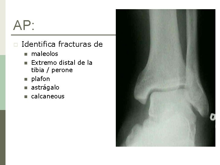 AP: p Identifica fracturas de n n n maleolos Extremo distal de la tibia