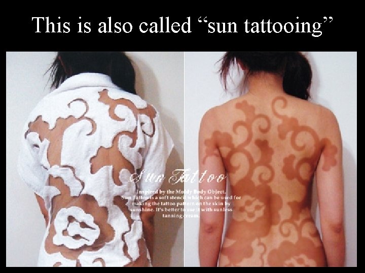 This is also called “sun tattooing” 