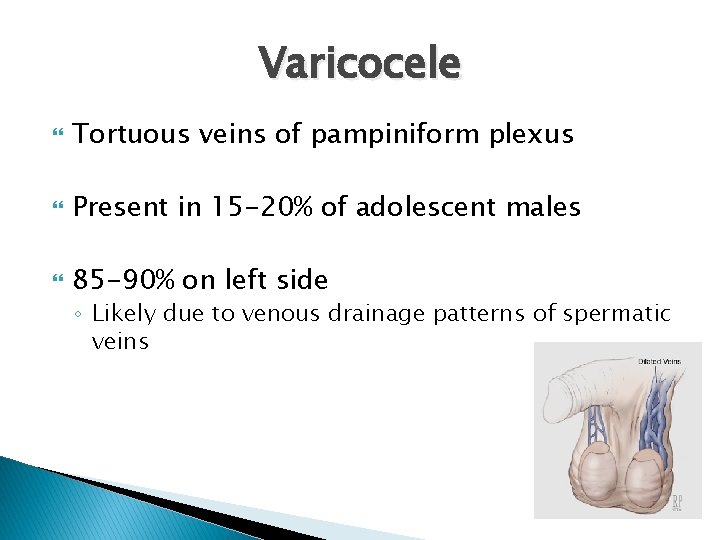 Varicocele Tortuous veins of pampiniform plexus Present in 15 -20% of adolescent males 85