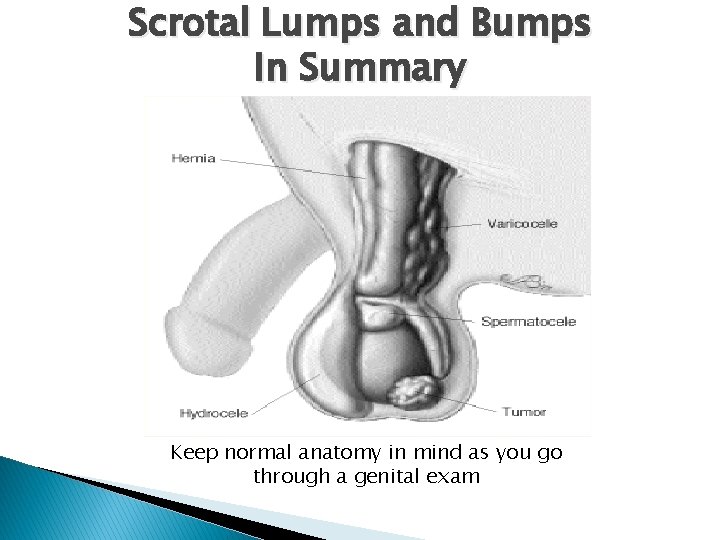 Scrotal Lumps and Bumps In Summary Keep normal anatomy in mind as you go