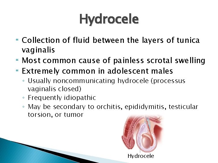 Hydrocele Collection of fluid between the layers of tunica vaginalis Most common cause of